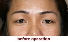 plastic-surgery-blepharoplasty